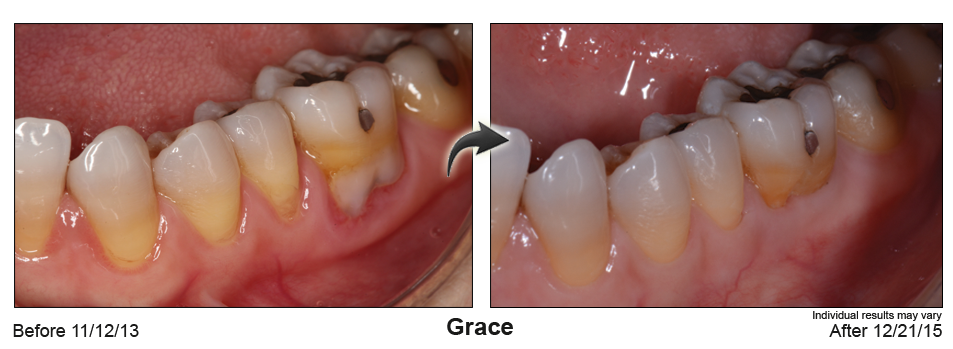 fix gum recession Colorado Springs