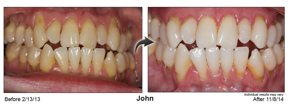 Colorado Springs gum recession