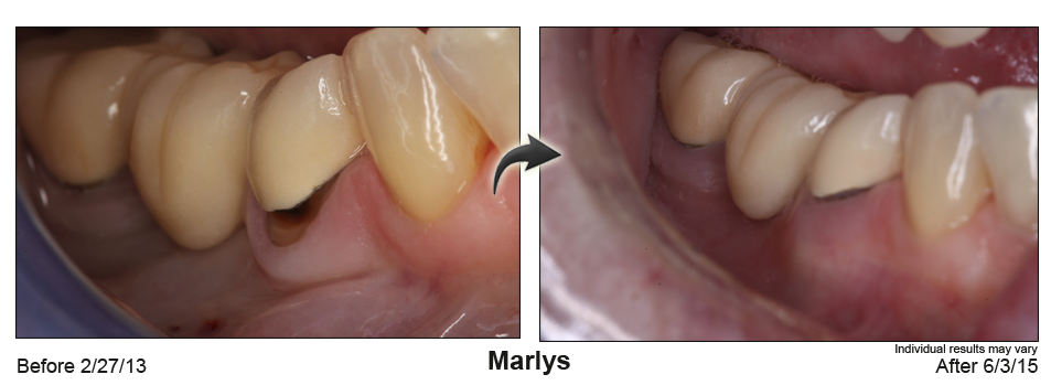 fix receding gums Colorado Springs